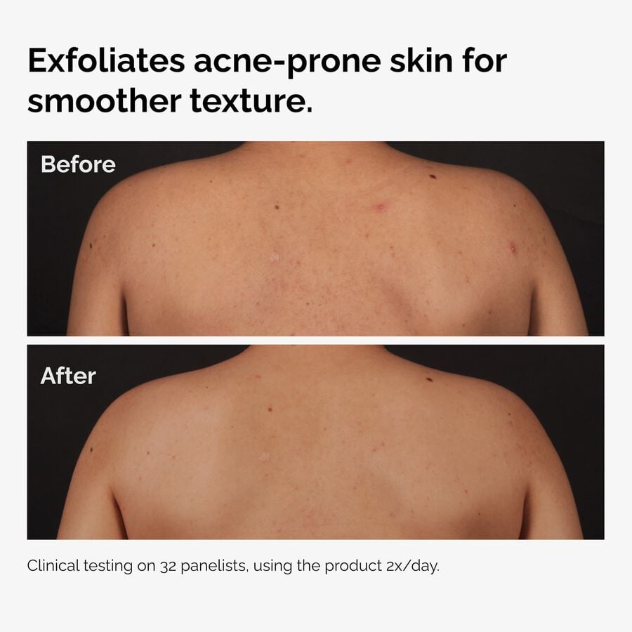 the-body-care-collection-t9 ord-salicylic-acid-body-serum-before-after-graphic-NA.jpg